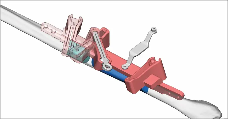 VSP - Planification chirurgicale virtuelle