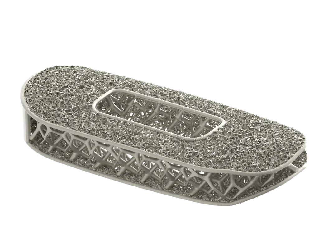 Implant rachidien optimisé par NuVasive produit par impression 3D