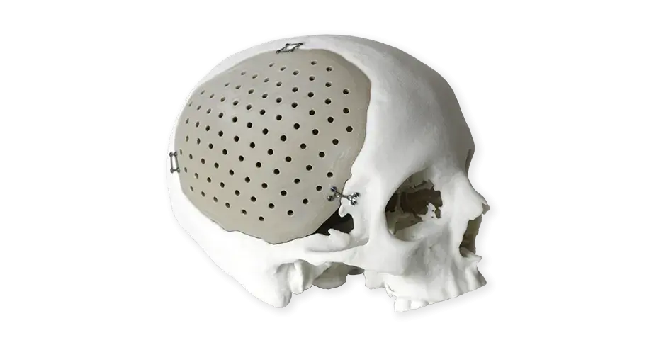 Implants crâniens en PEEK
