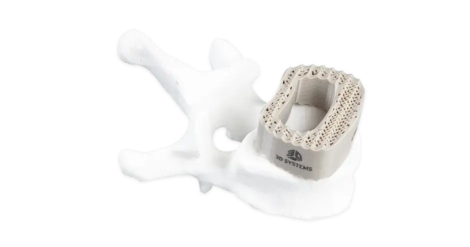 3Cage vertébrale imprimée en PEEK