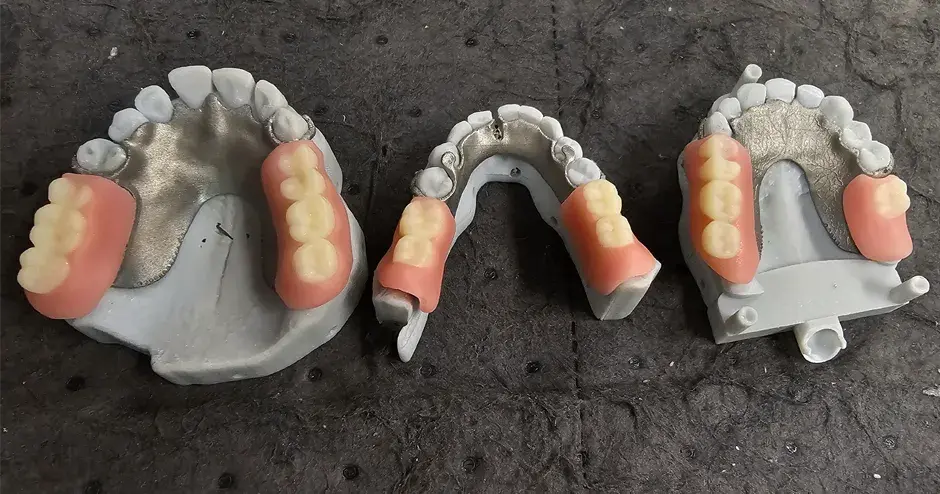 Prothèses dentaires imprimées en 3D